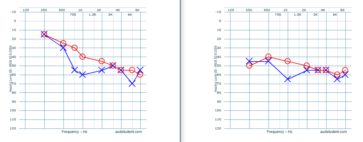 Audiograms, Improved Hearing Possibilities – What We Learned From Brad ...